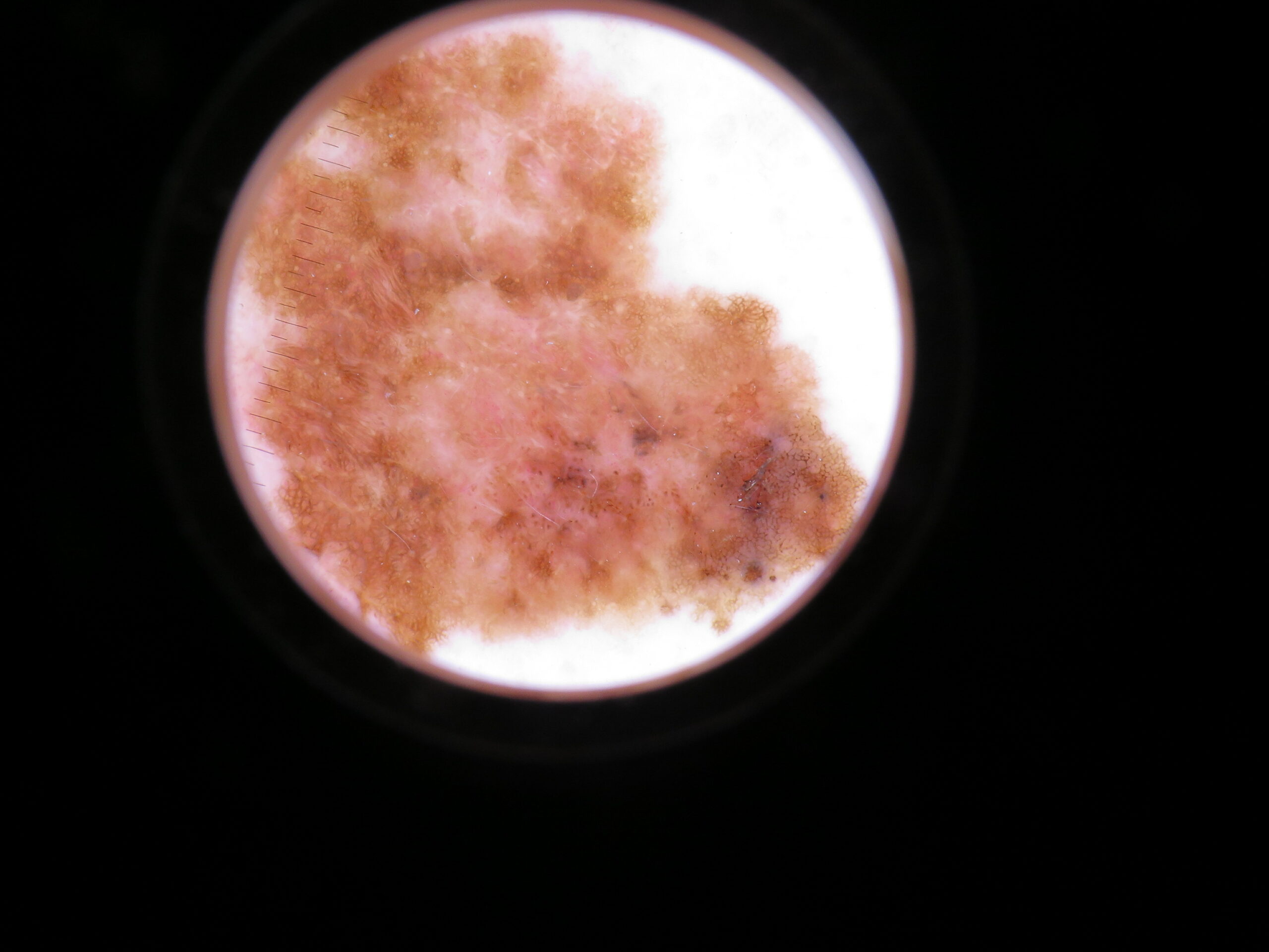 Dermoscopie zoom sur un mélanome